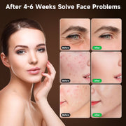 Morfone 05MRMBUSH-1 Red Light Therapy Face Mask, 4 Modes LED Skin Care Device, Portable Silicone, Remote Control, Pink, 05MRMBUSH-1