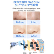 Ansten Pore Vacuum Face Cleaner Blackhead Remover kit Blackhead Remover Pore Vacuum Suction Electric Facial Pore Cleaner USB Rechargeable Blackhead Pimple Sucker for Nose Face Women Men
