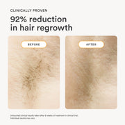 Nood Flasher 2.0 IPL Laser Hair Removal Device, Pain-Free Permanent Results, Matte Black, Corded KCA423